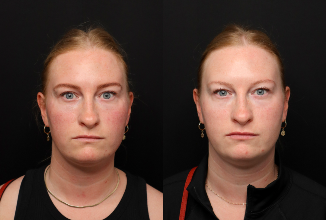 IPL photofacial before and after for rosacea and facial redness at Infinite Medical Spa in London, Ontario