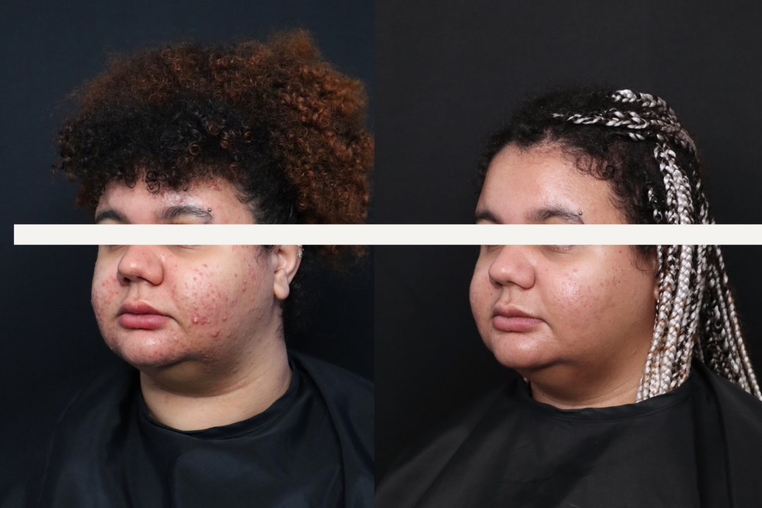 before and after results of a medical grade peel in London, Ontario at infinite medical spa.