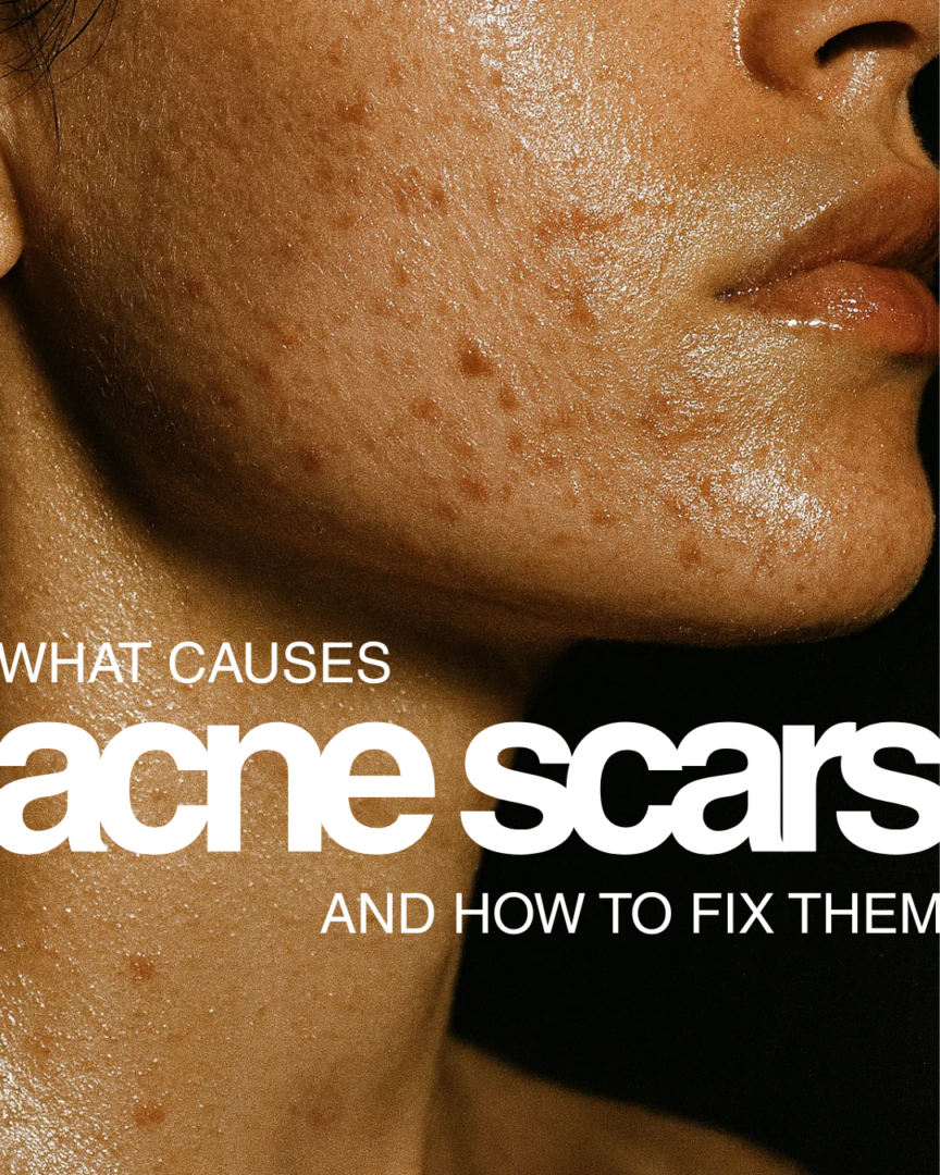 close up of a cheek with acne scars and text that reads what causes acne scars and how tot fix them