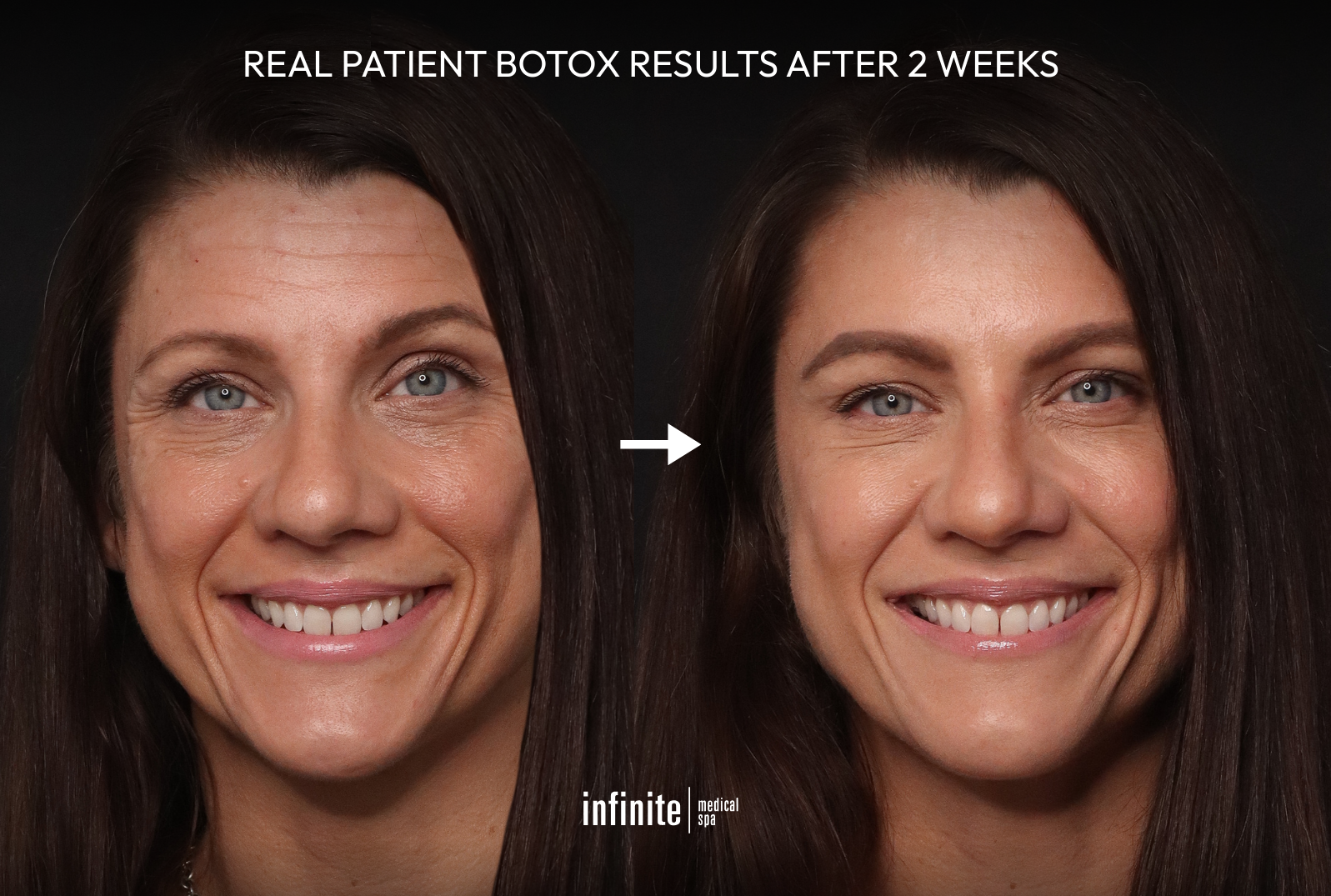 women in her 40's showing a before and after result of botox injections with a dramatic reduction in fine lines and wrinkles