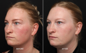 Intense pulsed light therapy before and after for rosacea and facial redness — natural, harmonized skin results at Infinite Medical Spa London Ontario
