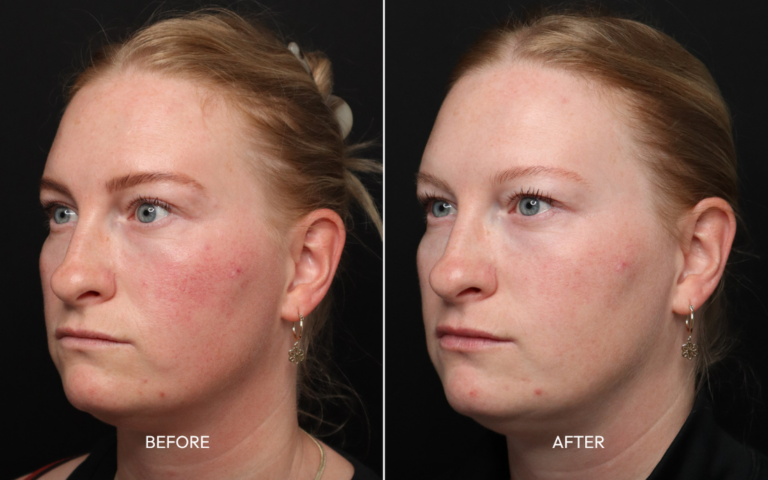 Intense pulsed light therapy before and after for rosacea and facial redness — natural, harmonized skin results at Infinite Medical Spa London Ontario