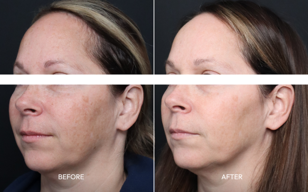 IPL skin rejuvenation before and after for sun damage and pigment correction on face — natural, even complexion results at Infinite Medical Spa London Ontario