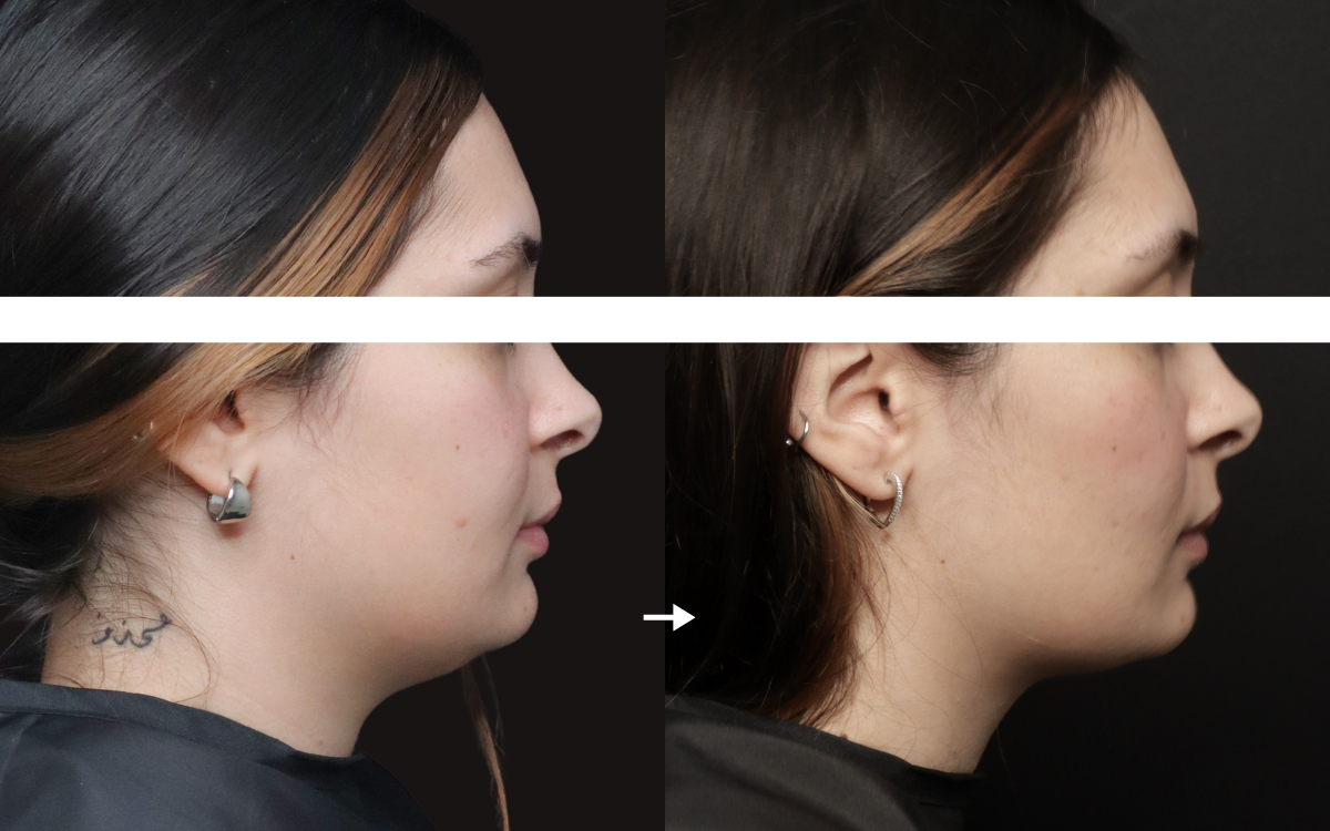 Belkyra Fat Dissolving Double Chin Before and After at Infinite Medical Spa in London, Ontario