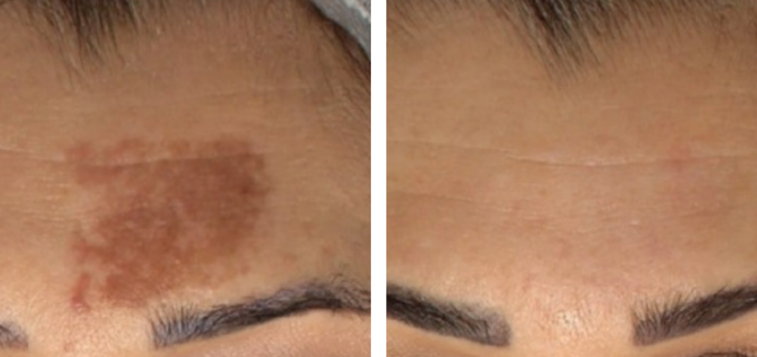 Toro Laser Deep Pigment reduction Before and After results at Infinite Medical Spa