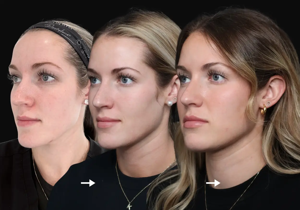Before and after results showing skin improvement after 3 microneedling sessions at Infinite Medical Spa in London, Ontario