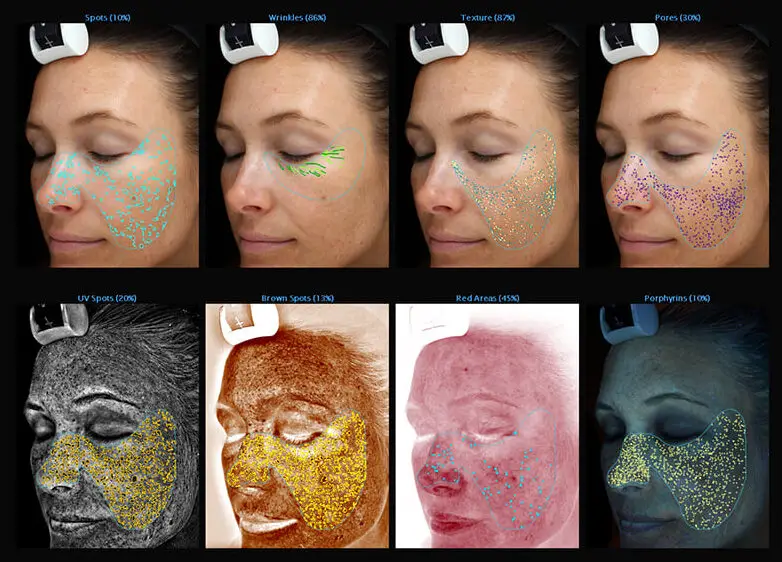 Visia Skin Analysis results screen showing the 8 metrics that score the patients skin at Infinite Medical Spa in London, ON.