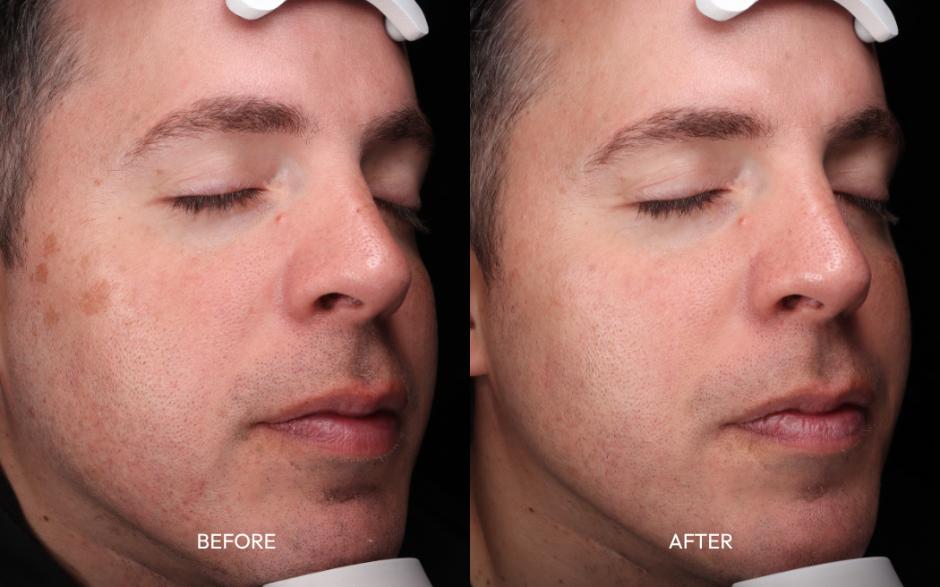 Before and after 3 sessions of Toro laser pigment reduction showing faded sun spots on a man's right cheek at Infinite Medical Spa in London, Ontario
