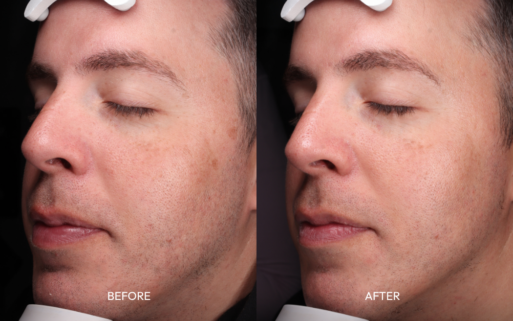 Man's left cheek before and after 3 Toro laser sessions for sun damage and pigmentation, treated in London, Ontario