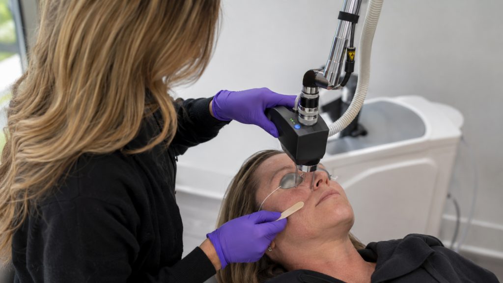 CoolPeel CO2 laser resurfacing being performed at Infinite Medical Spa in London, Ontario