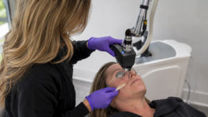 CoolPeel CO2 laser resurfacing being performed at Infinite Medical Spa in London, Ontario