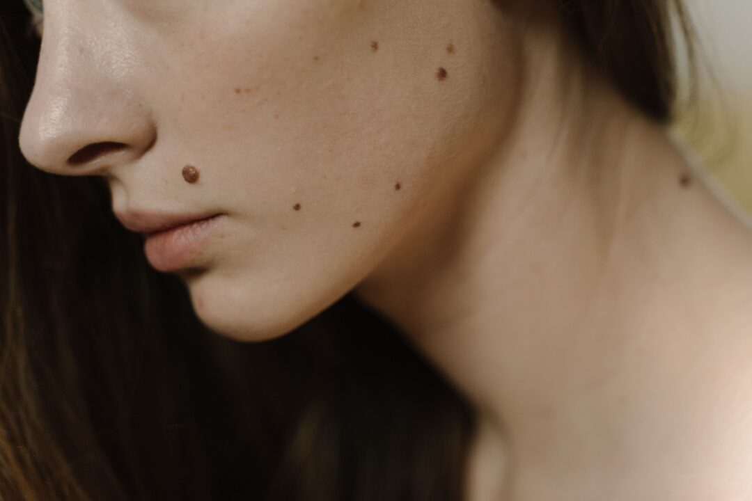 Close-up of a raised brown mole on skin before cosmetic mole and skin lesion removal by Infinite Medical Spa in London, Ontario