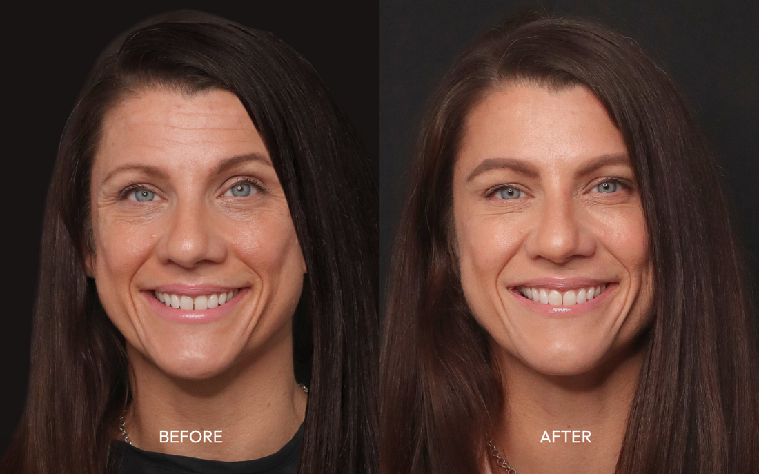 Dysport results before and after while smiling, reduced fine lines around the eyes, nurse injector at Infinite Medical Spa London Ontario