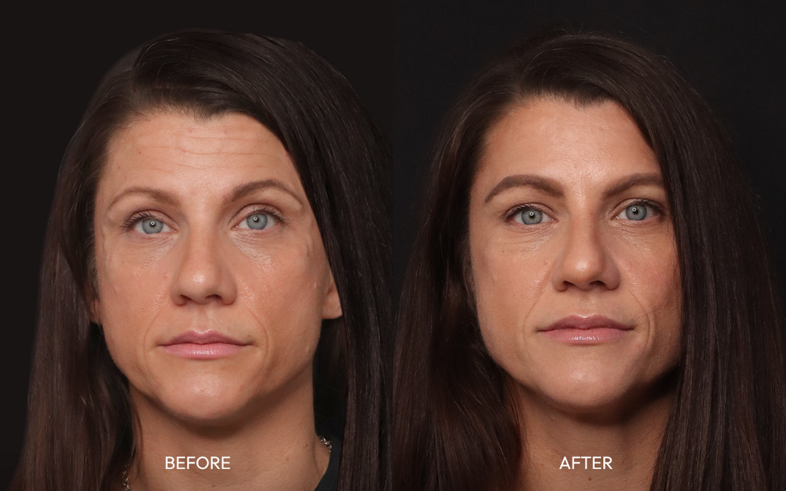 Dysport for forehead and frown lines, before and after at rest, undetectable natural result at Infinite Medical Spa London Ontario