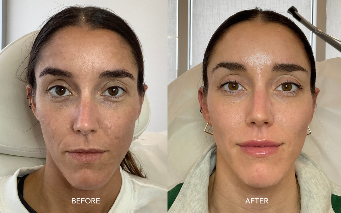 Dysport before and after at rest, smoother forehead and frown lines with harmonized natural results, Infinite Medical Spa London Ontario