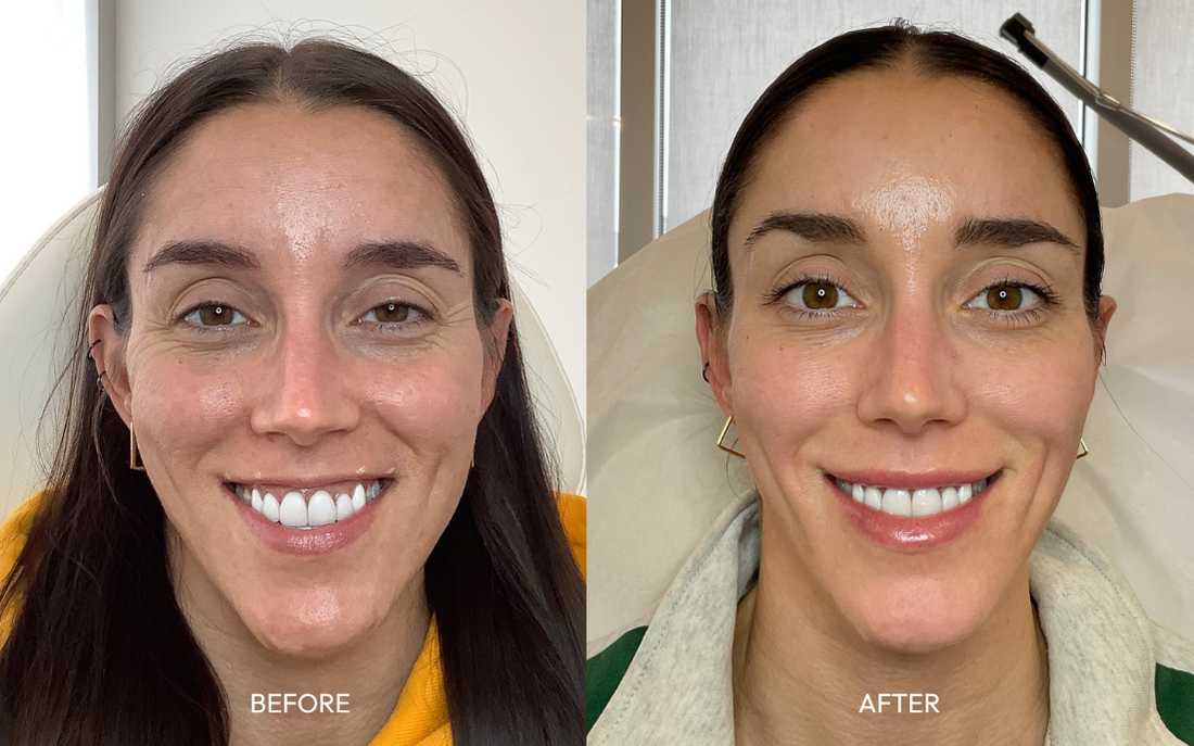 Dysport before and after smiling, softer crow's feet and forehead lines with natural expression, Infinite Medical Spa London Ontario