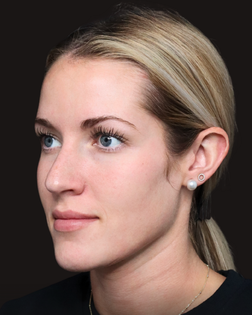 Kylee microneedling with VAMP, After 2 sessions