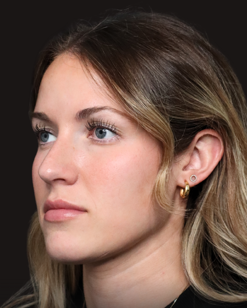 Kylee microneedling with VAMP, After 3 sessions